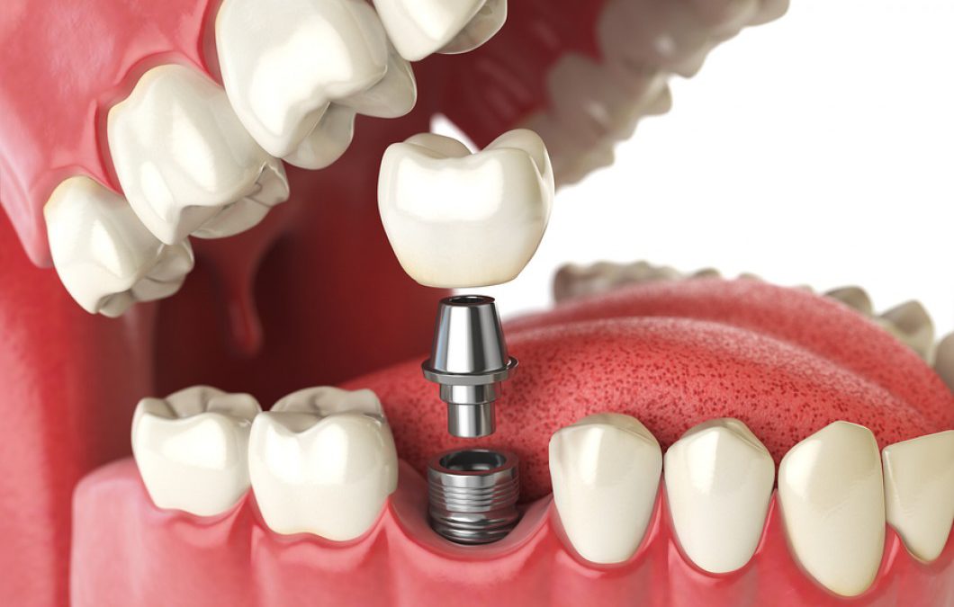 preço do implante dentário em belo horizonte