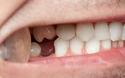 Perda dentária: 5 motivos e como prevenir