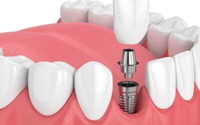 Implante dentário dói? Saiba mais sobre este tratamento.