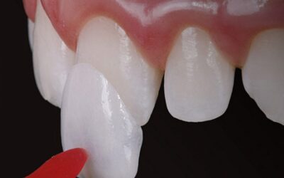 Vale a pena colocar faceta dental ou lente de contato dental?