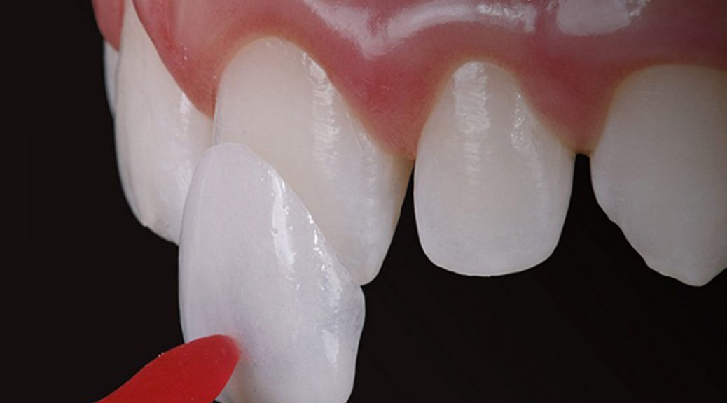 Vale a pena colocar faceta dental ou lente de contato dental?