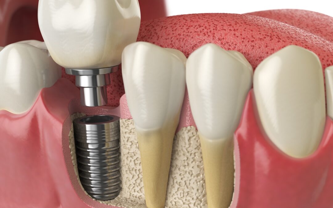 Implante dentário: valor, fatores que influenciam e o que considerar antes do tratamento