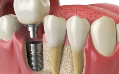 Implante dentário: valor, fatores que influenciam e o que considerar antes do tratamento