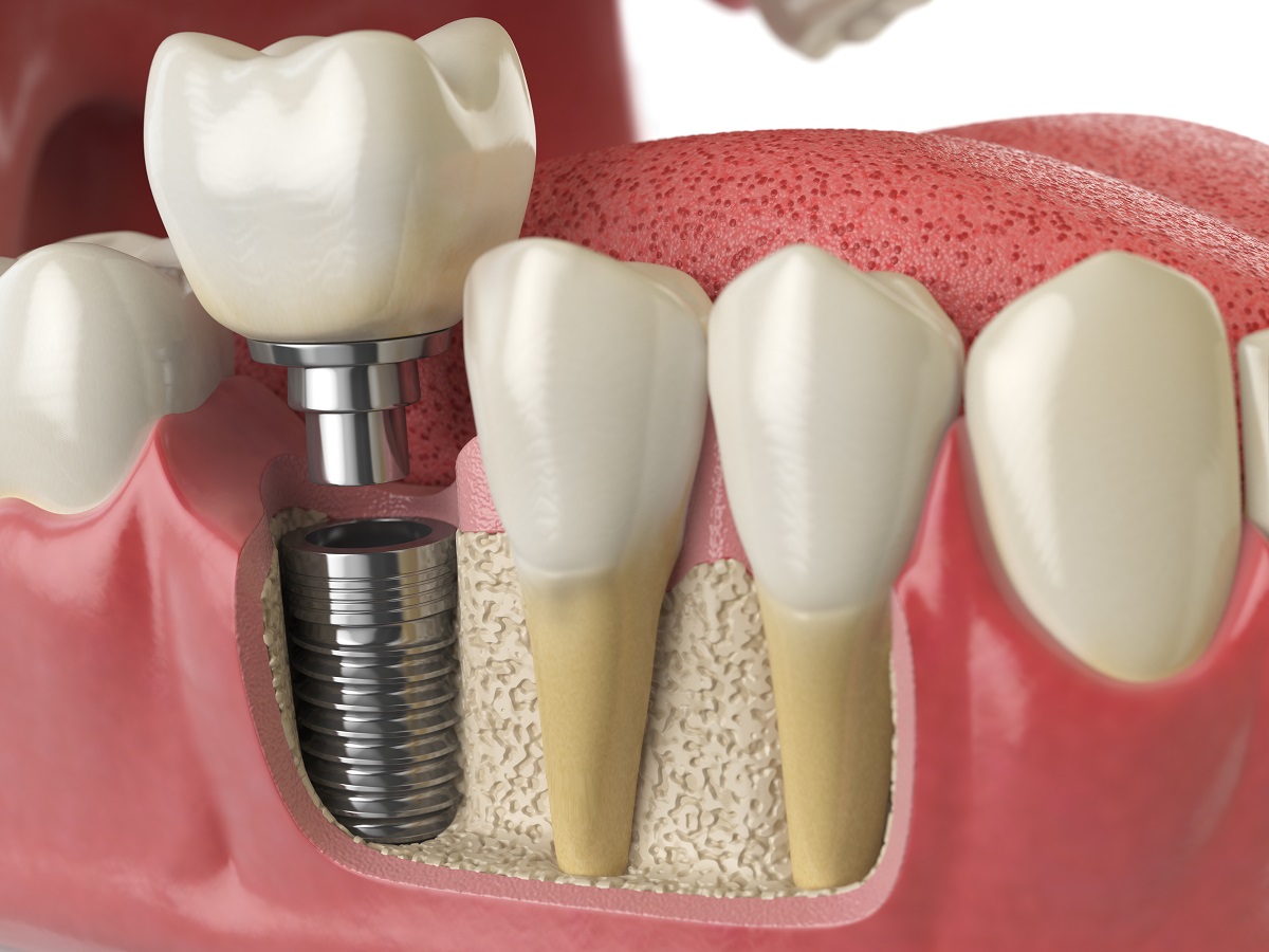 Implante dentário: valor, fatores que influenciam e o que considerar antes do tratamento